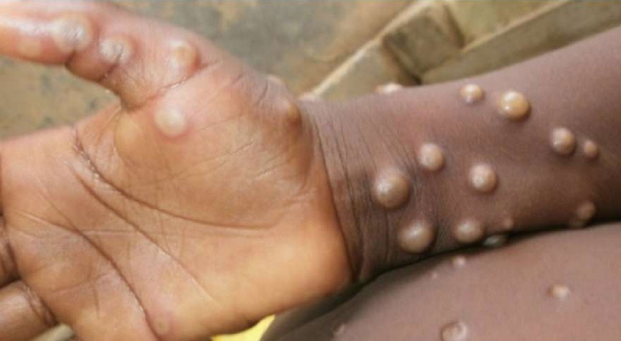 Yeni tehlike: Maymun çiçeği virüsü yayılıyor! Maymun çiçeği virüsü nedir, insandan insana bulaşır mı? Türkiye’de görüldü mü? Belirtileri ve tedavisi