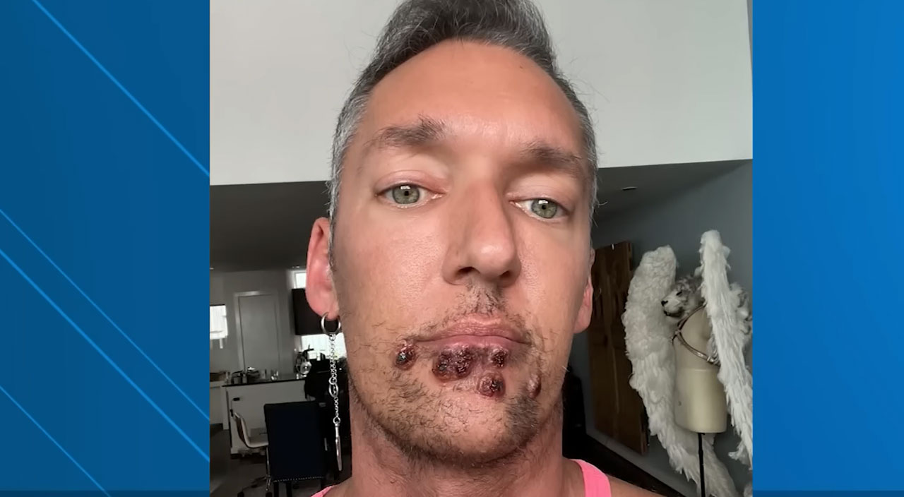 Maymun çiçeği hastası yaşadıklarını anlattı: “Uyurken yastığa kafamı bile koyamıyorum, canım çok yanıyor”