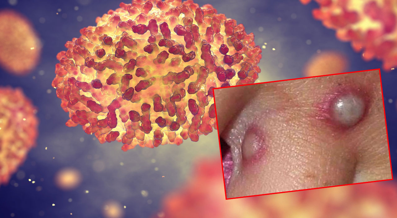 7 SORU 7 CEVAP l Git gide yayılıyor... Maymun çiçeği hastalığı hakkında ne biliyoruz?