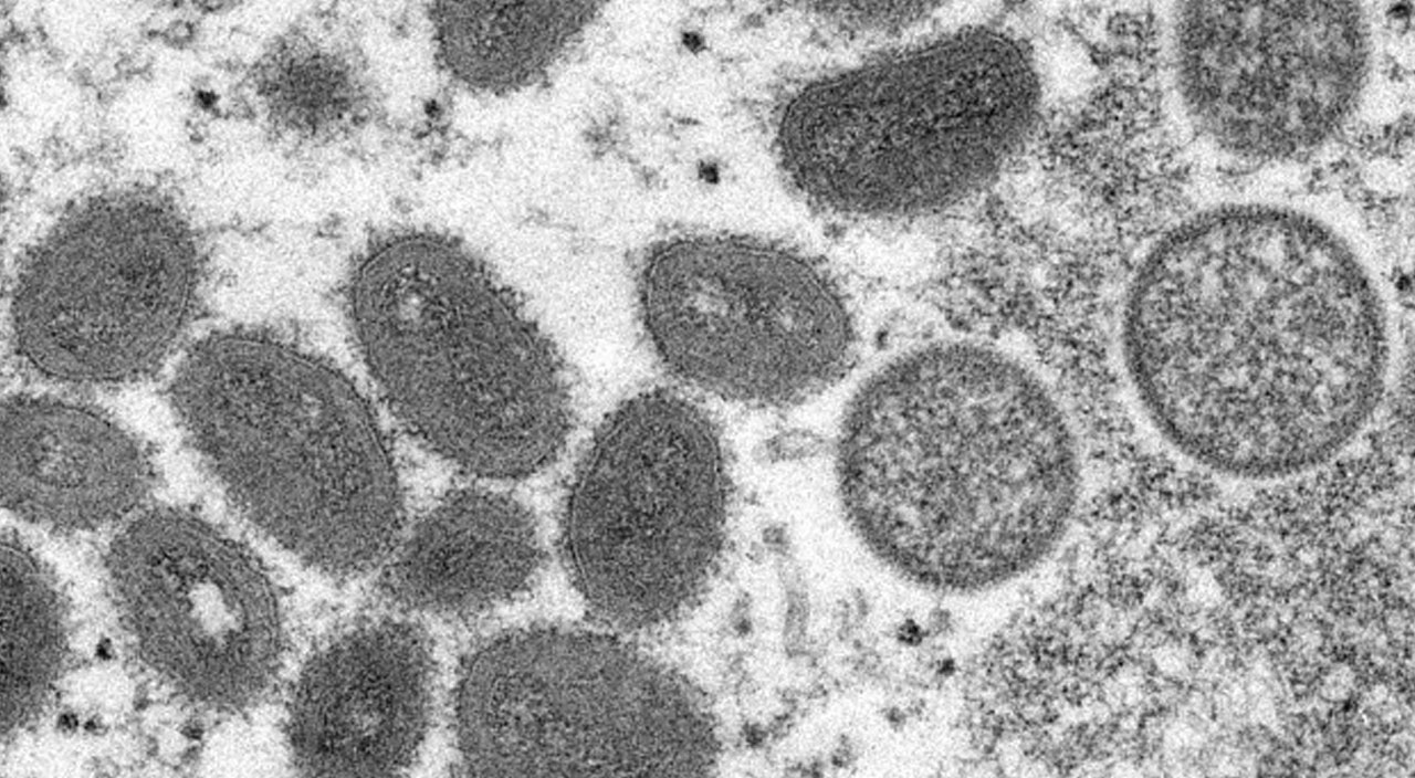Dünya diken üstünde! Maymun çiçeği virüsü hızla yayılıyor: CDC’den dikkat çeken açıklama Dünya diken üstünde! Maymun çiçeği virüsü hızla yayılıyor: CDC’den dikkat çeken açıklama