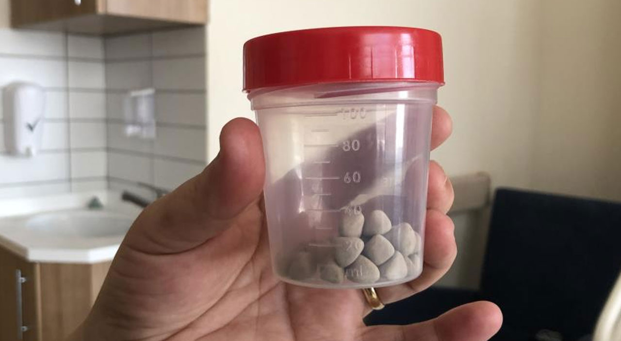 Mesanesinden çıkan fındık büyüklüğündeki 39 taştan tesbih yapacak