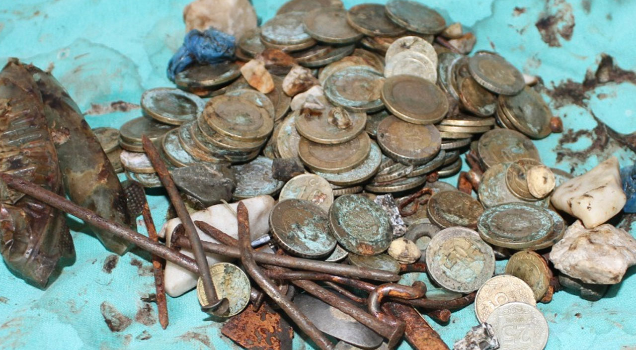 Madeni para, pil, mıktanıs, çivi ve dahası... Midesinden tam 233 cisim çıktı