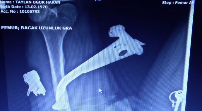 Doktorlarda şok oldu: Motosikletin ayaklığı bacağına saplandı