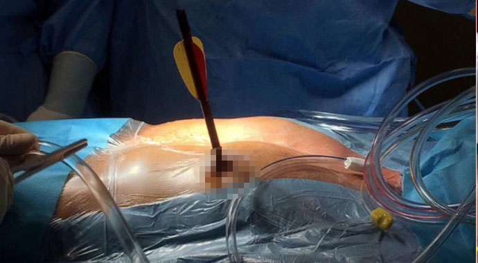 Kalbine saplanan 30 santimlik okla hastaneye geldi