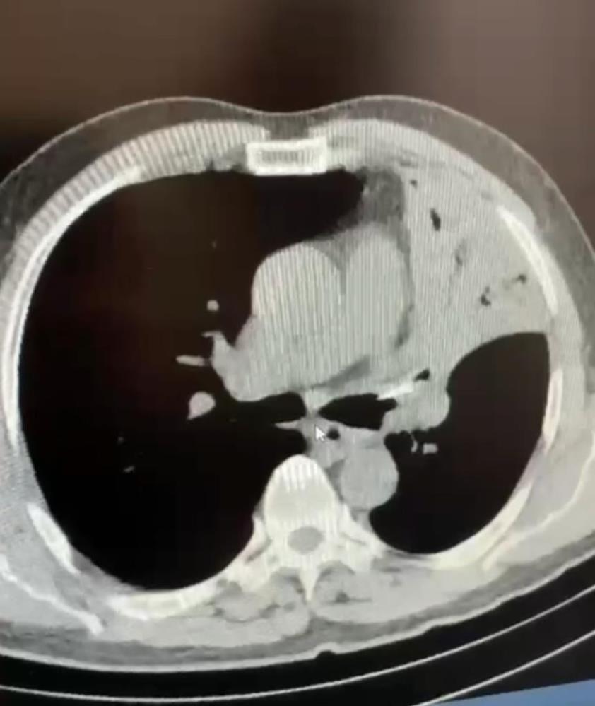Öksürük şikayetiyle gittiği hastanede hayatının şokunu yaşadı!