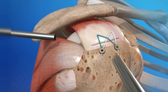 Omuz artroskopisi nedir? | Omuz artroskopisi ne kadar sürer? | Artroskopi’nin riskleri, tedavisi Omuz artroskopisi nedir? | Omuz artroskopisi ne kadar sürer? | Artroskopi’nin riskleri, tedavisi