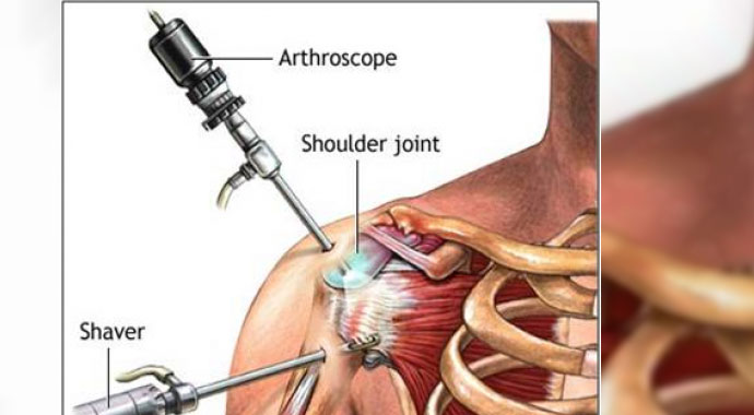 Omuz artroskopisi nedir? | Omuz artroskopisi ne kadar sürer? | Artroskopi’nin riskleri, tedavisi Omuz artroskopisi nedir? | Omuz artroskopisi ne kadar sürer? | Artroskopi’nin riskleri, tedavisi