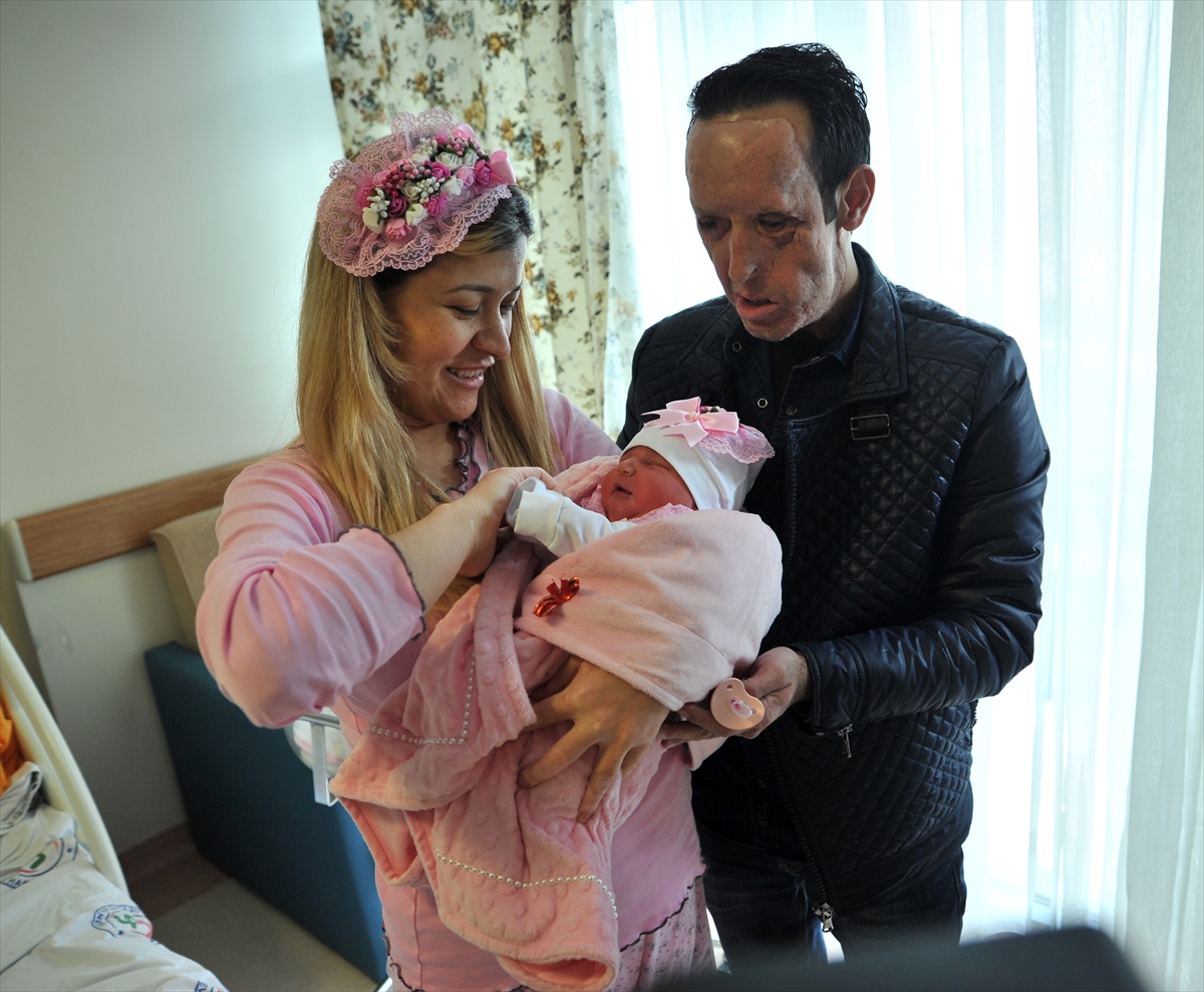 Yüz nakilli Recep Sert baba oldu Yüz nakilli Recep Sert baba oldu