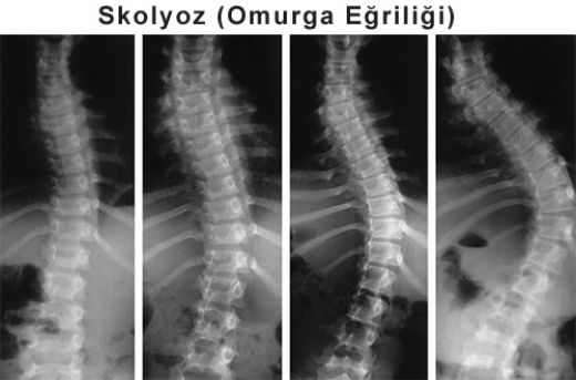 Skolyoz nedir, Skolyoz nasıl tedavi edilir? (Skolyoz Tedavi)