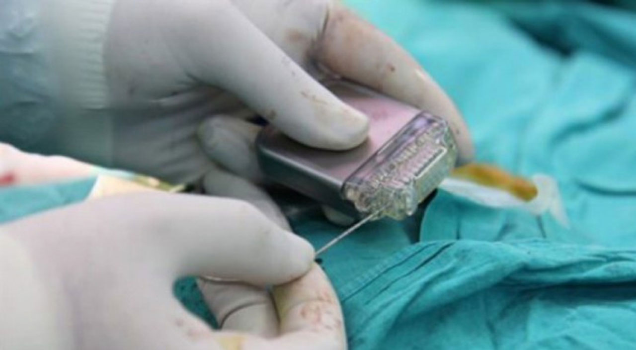 Dr. Ali Zırh: Beyin pili, sara obezite Alzheimer gibi birçok hastalığa çözüm olabilir