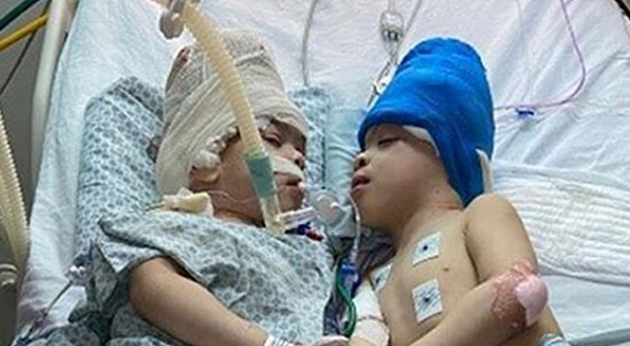 Siyam ikizleri 27 saatlik ameliyatla ayrıldı… “Operasyon Mars'a adam göndermek gibiydi” Siyam ikizleri 27 saatlik ameliyatla ayrıldı… “Operasyon Mars'a adam göndermek gibiydi”