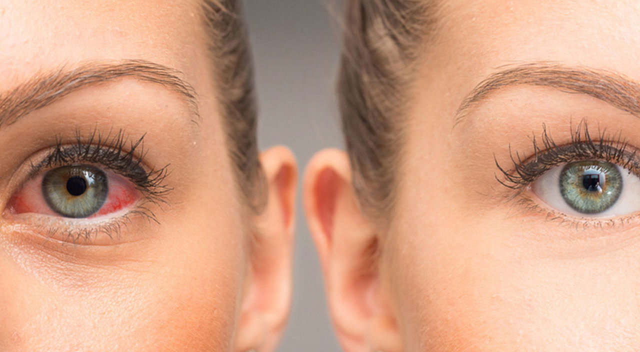 Omicron’da yeni belirti ‘pembe göz’: İyileşmesi 2-3 hafta sürüyor