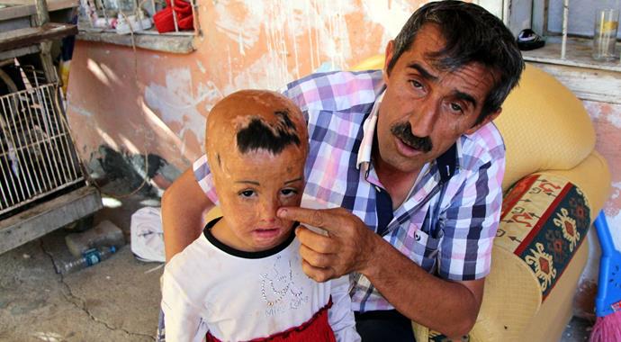 Evlerine düşen bombayla yüzü parçalanan küçük kızın dramı