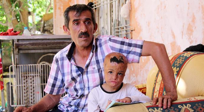 Evlerine düşen bombayla yüzü parçalanan küçük kızın dramı