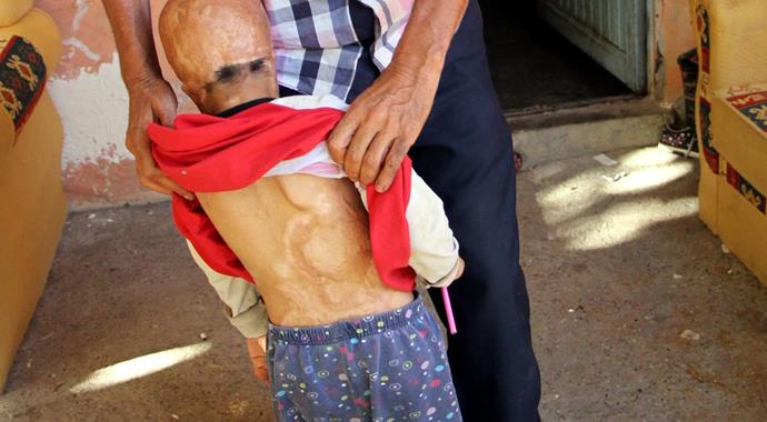 Evlerine düşen bombayla yüzü parçalanan küçük kızın dramı