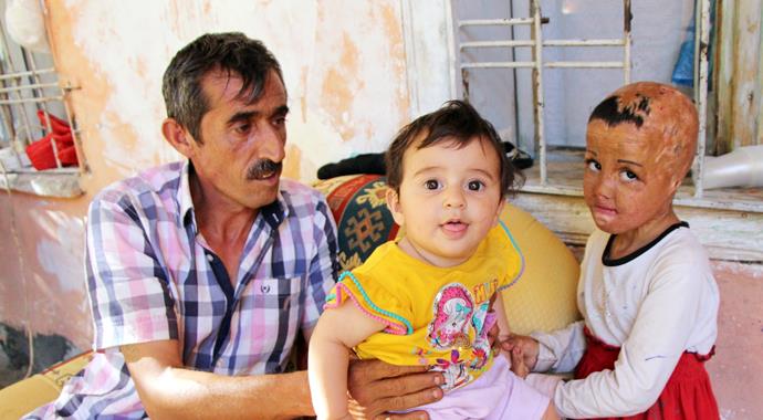 Evlerine düşen bombayla yüzü parçalanan küçük kızın dramı