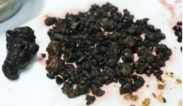 10 yıldan beri kahvaltı yapmayan kadının midesinden çıkanlar şoke etti!