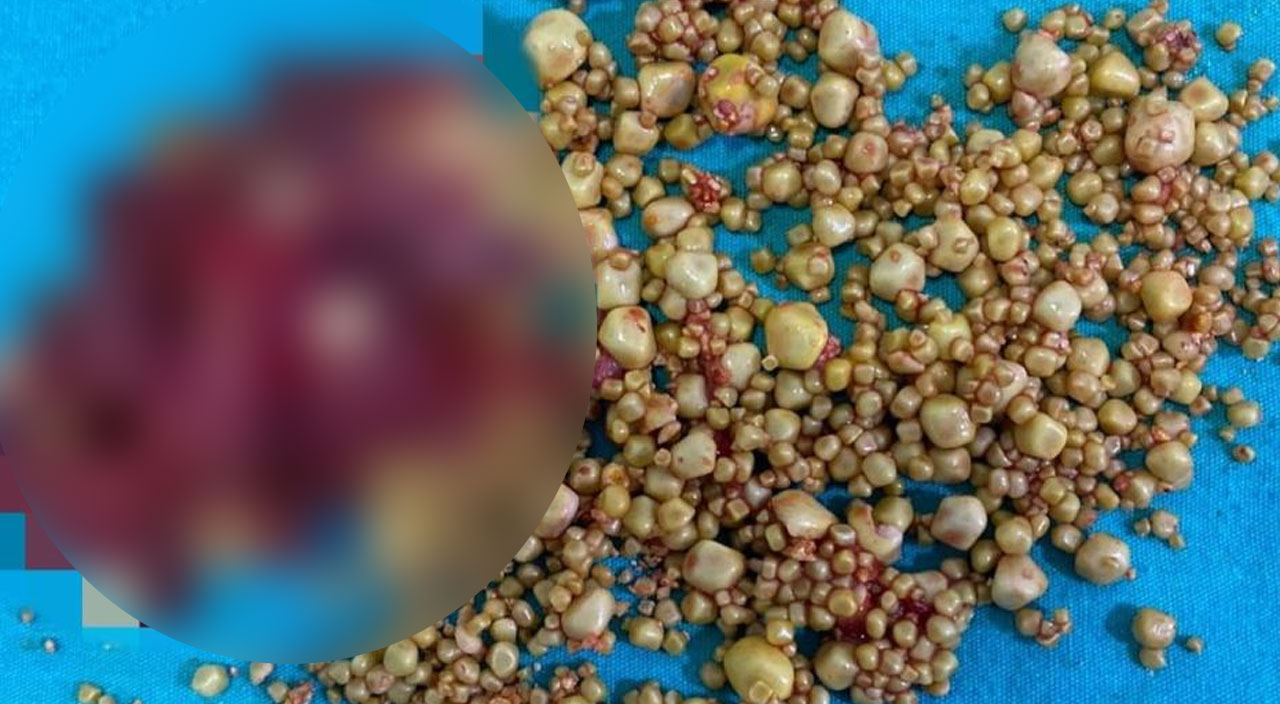 Karın ağrısı şikayetiyle hastaneye gitti, safra kesesinden çıkanlar doktorları bile şaşırttı