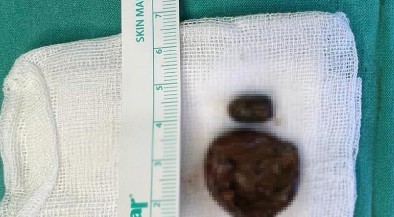 50 yıldır burnunda… Çıkanı görünce, doktorlar bile şaştı!