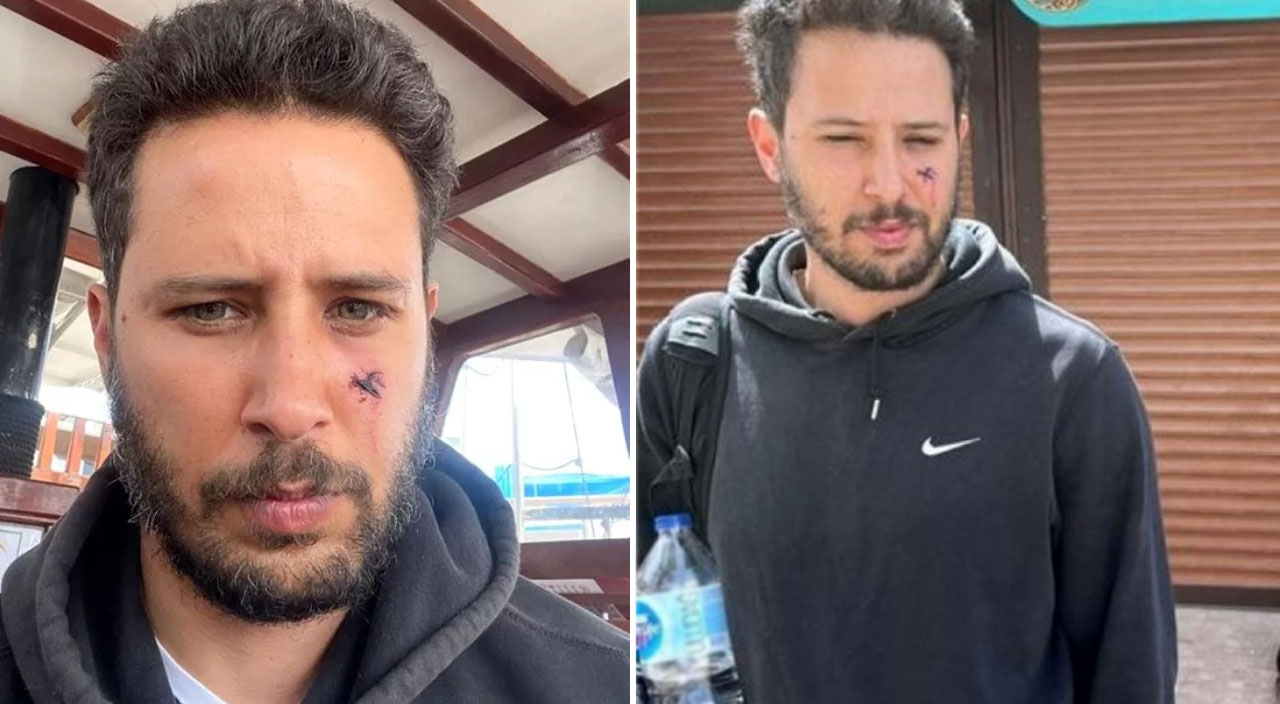 Tuan Tunalı’nın yüzünü köpek ısırdı, neredeyse gözünden oluyordu