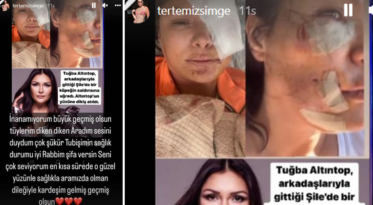 Şarkıcı Tuğba Altıntop köpek saldırısına uğradı: Yüzüne dikiş atıldı! İşte son hali…