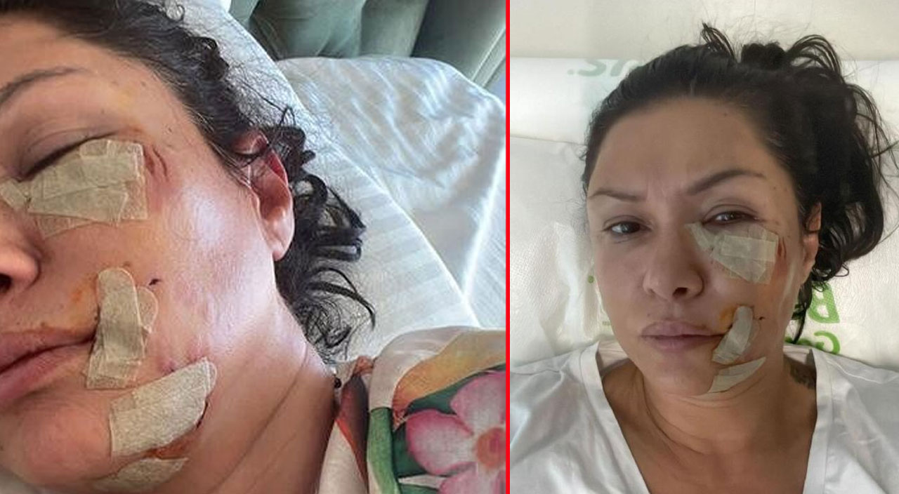 Şarkıcı Tuğba Altıntop köpek saldırısına uğradı: Yüzüne dikiş atıldı! İşte son hali…