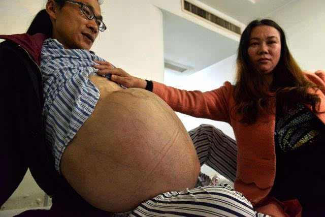 Çinli adamın karnından 31 kiloluk tümör çıktı