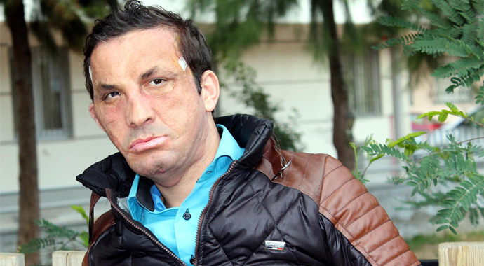 İlk Yüz nakilli Uğur Acar hastaneye kaldırıldı