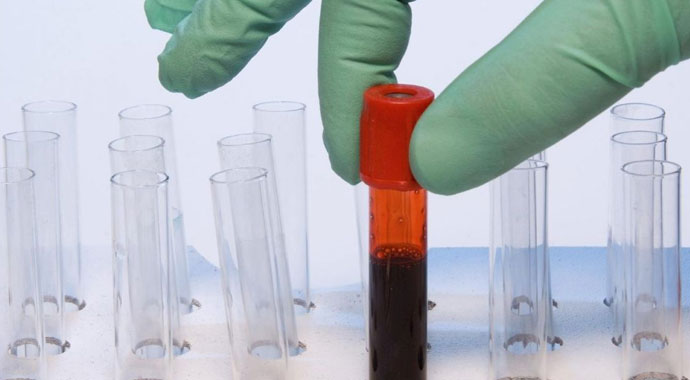 Kanda UIBC Nedir? | UIBC düşüklüğü | UIBC yüksekliği | UIBC'de normal değerler | UIBC düşüklüğü/yüksekliği nasıl normale döner?