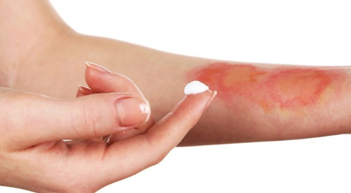 Yanığa ne iyi gelir? Diş macunu yanığa iyi gelir mi? Yoğurt yanığa iyi gelir mi?