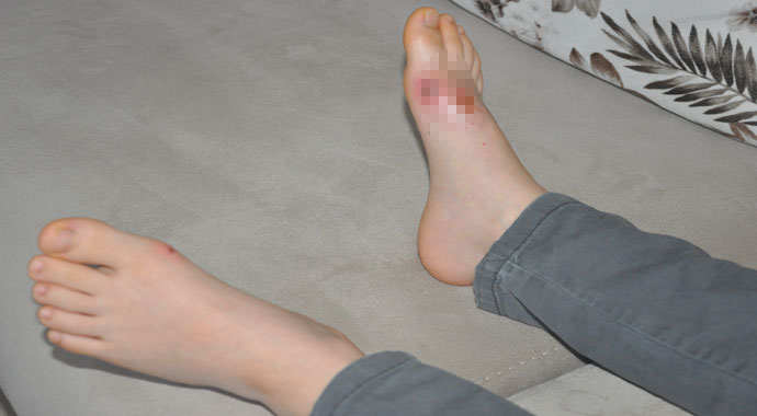 Kar topu oynarken vücudunda yanık oluşan öğrencinin babası konuştu