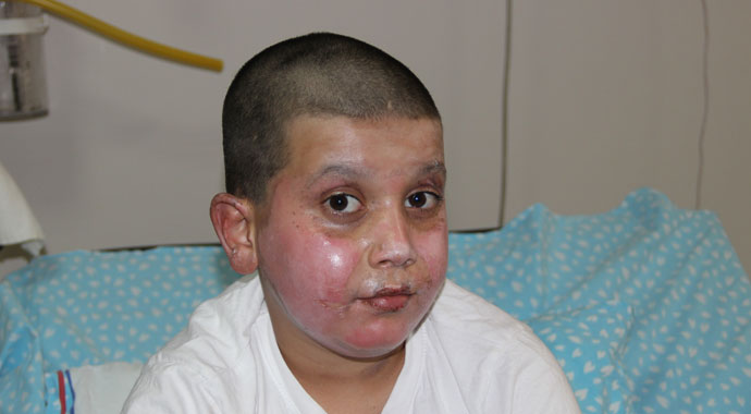 Sprey kutusu patladı, küçük çocuğun yüzü feci şekilde yandı