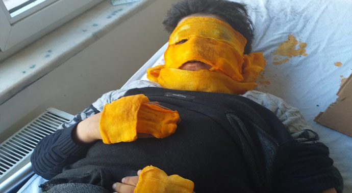 Sprey kutusu patladı, küçük çocuğun yüzü feci şekilde yandı