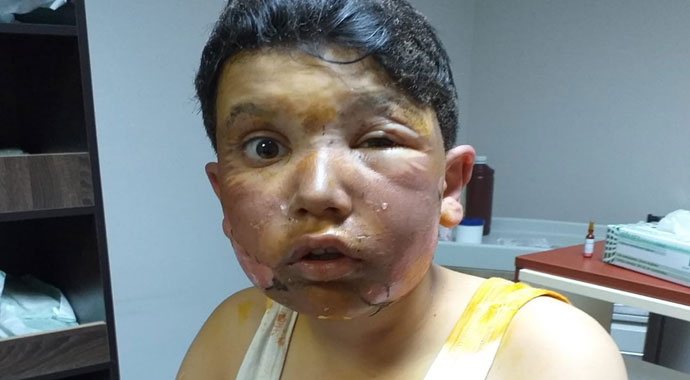 Sprey kutusu patladı, küçük çocuğun yüzü feci şekilde yandı