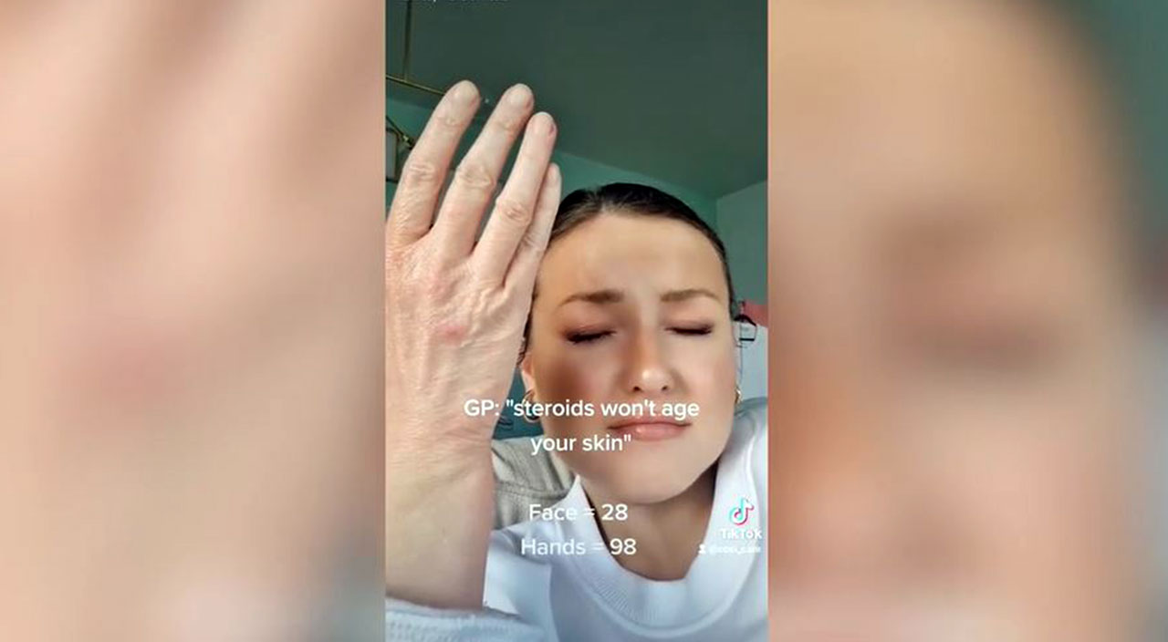 Elleri yüzünden yıllarca alay konusu oldu: “28 yaşındayım ama ellerim büyükanneme ait gibi”