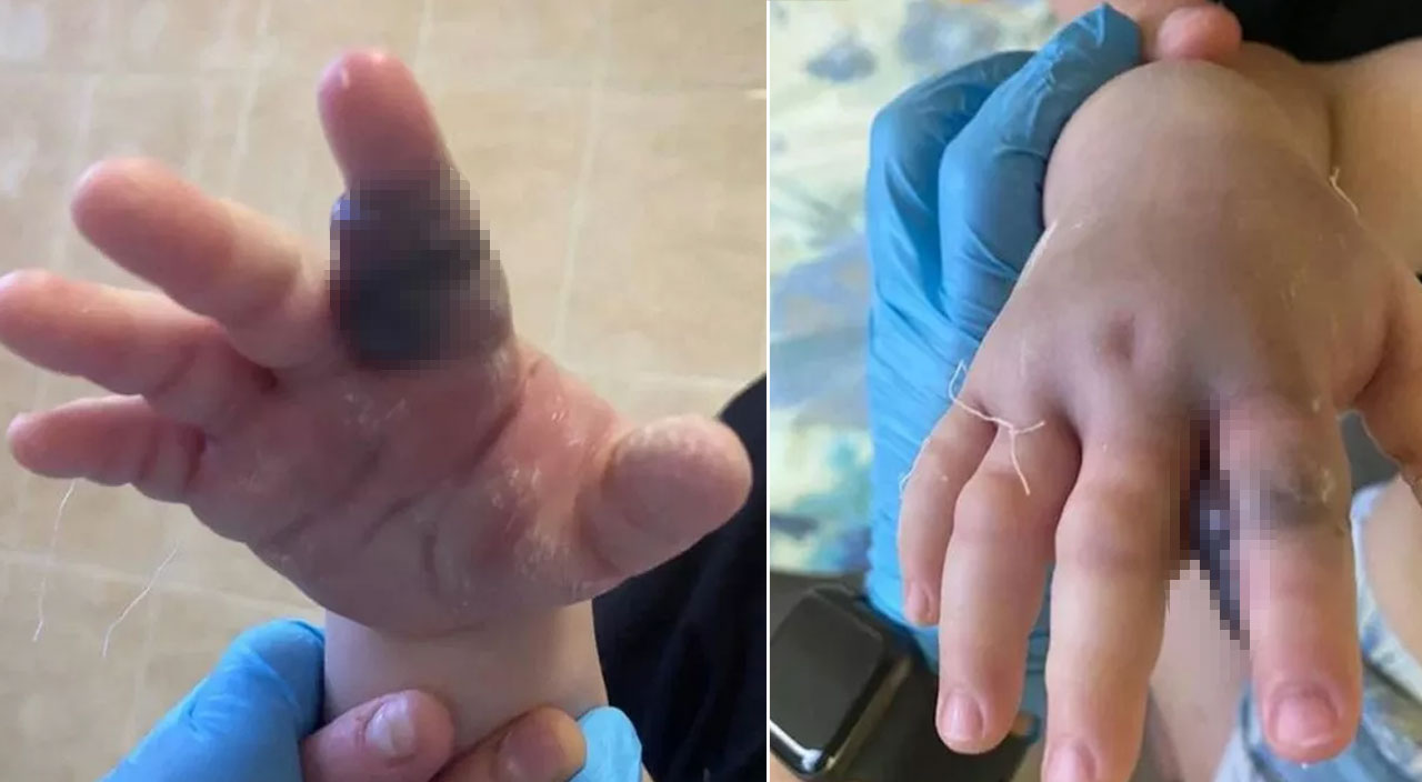 1 yaşındaki çocuğu engerek yılanı ısırdı, annesi elini görünce şoku yaşadı 1 yaşındaki çocuğu engerek yılanı ısırdı, annesi elini görünce şoku yaşadı