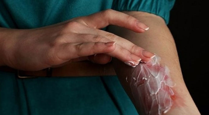 Yanığa ne iyi gelir? Diş macunu yanığa iyi gelir mi? Yoğurt yanığa iyi gelir mi?