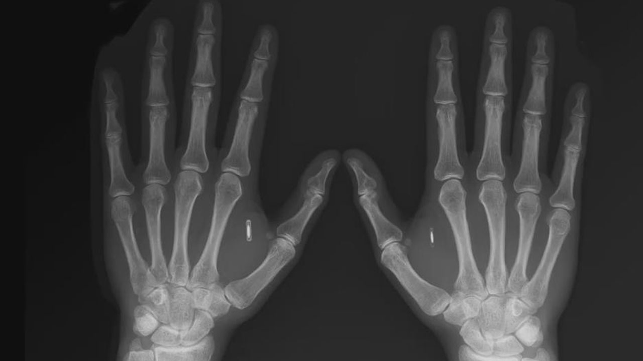 Derisinin altına çip yerleştirdi