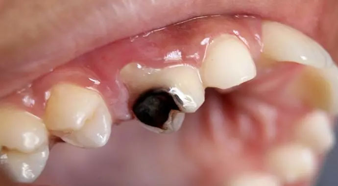 Diş ağrısı nasıl geçer? | Diş ağrısı için evde tedavi yöntemleri | Diş eti neden kanar? | Diş çürüğünün zararları neler?