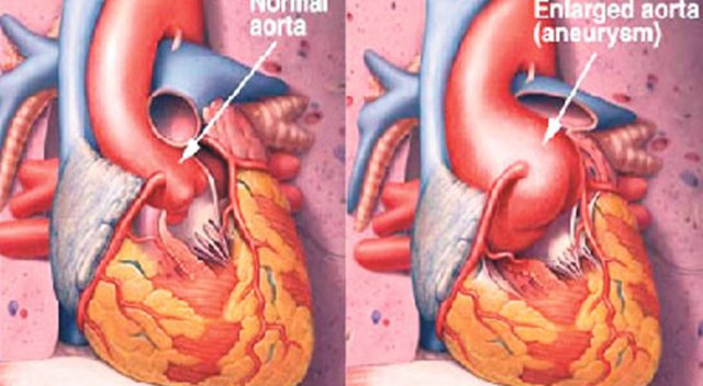’Aort yırtılması’ nedir? ’Aort yırtılması’ nedir?