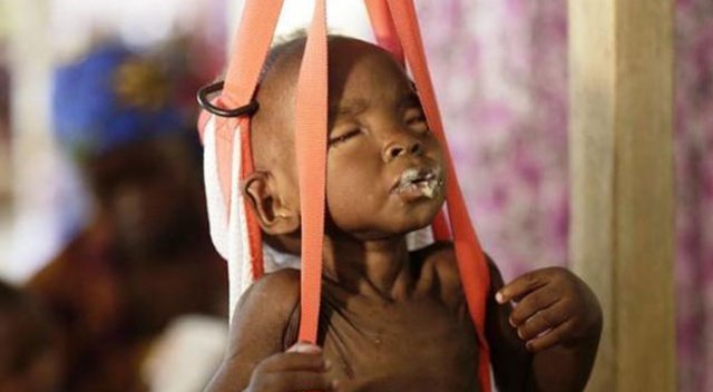 UNICEF: 75 binin üzerinde çocuk açlıktan ölebilir UNICEF: 75 binin üzerinde çocuk açlıktan ölebilir