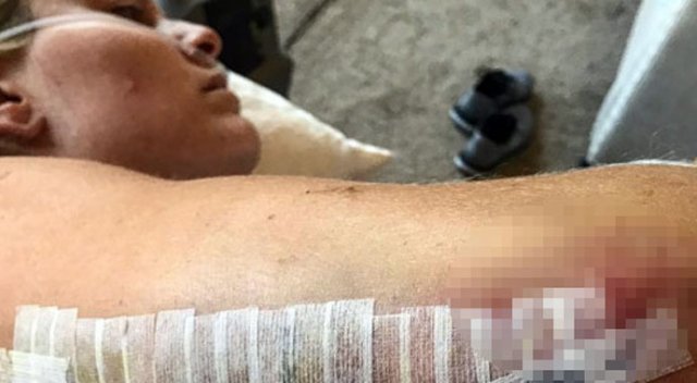 ABD'li kayakçı Lindsey Vonn, dikiş atılan kolunun fotoğrafını paylaştı ABD'li kayakçı Lindsey Vonn, dikiş atılan kolunun fotoğrafını paylaştı