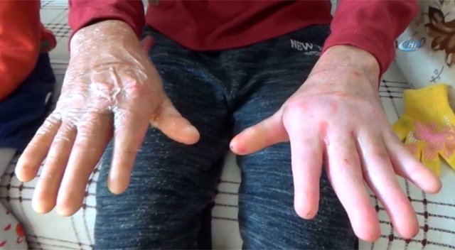 Kelebek hastası gencin en büyük hayali okumak Kelebek hastası gencin en büyük hayali okumak