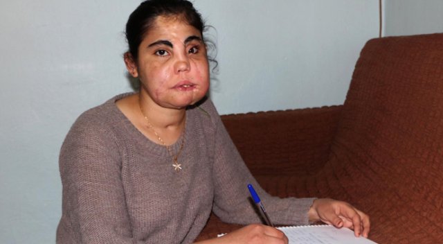 Türkiye'nin yüz nakli yapılan ilk kadını Hatice Nergis öldü Türkiye'nin yüz nakli yapılan ilk kadını Hatice Nergis öldü