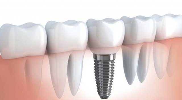 22 ülkeye implant satıyor