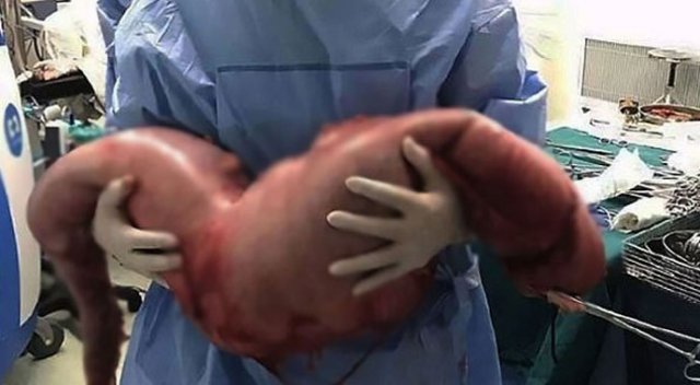 Bağırsağından 13 kilo dışkı çıktı Bağırsağından 13 kilo dışkı çıktı