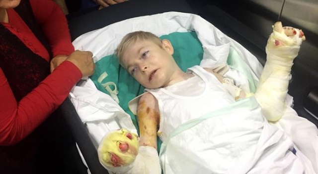 31&#039;inci ameliyatını olan kelebek hastası çocuk umudunu koruyor