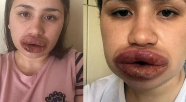 'Dudak dolgusuyla yaralama' davasında bilirkişi bekleniyor 'Dudak dolgusuyla yaralama' davasında bilirkişi bekleniyor
