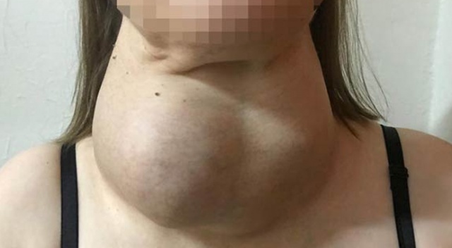 Ameliyattan korktu yıllarca böyle yaşadı