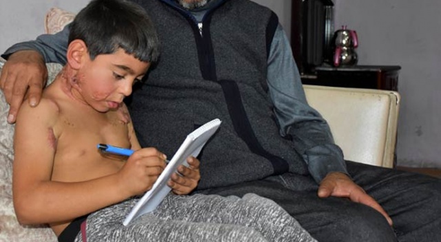 Siraç, vücudundaki yanıklar yüzünden okula gitmiyor